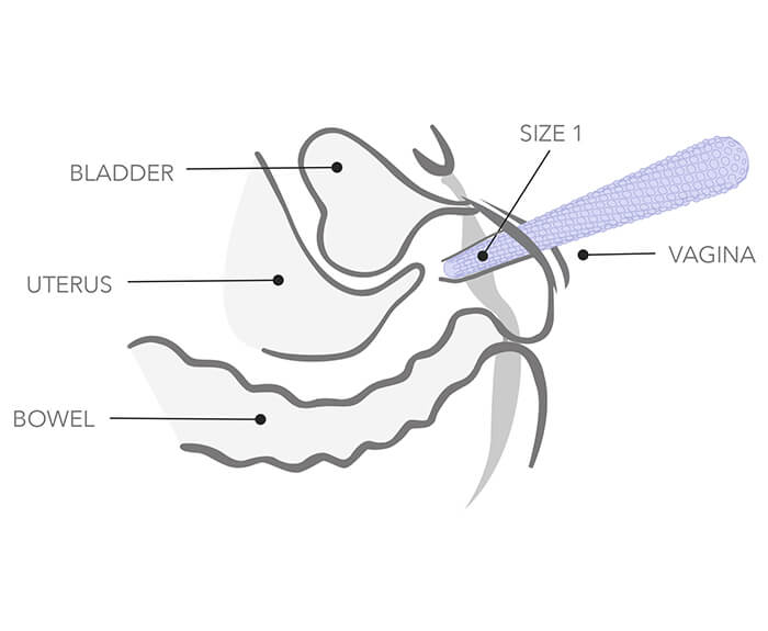 Internal Illustration of womans vagina with dilator