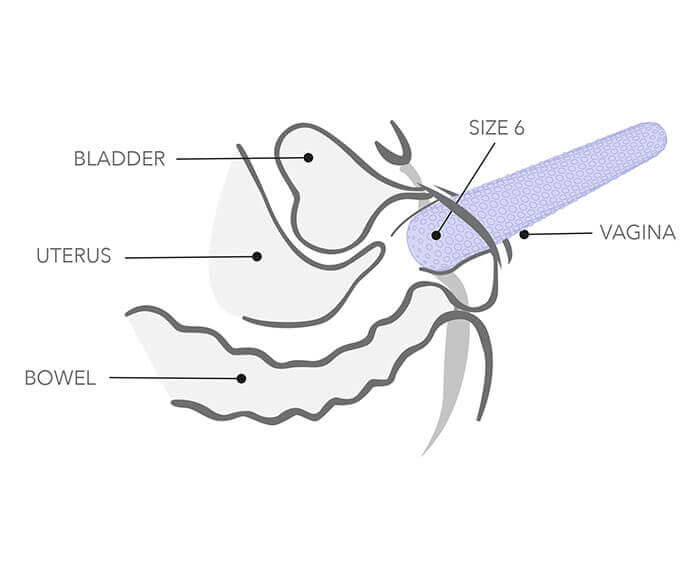 Internal Illustration of womans vagina with dilator